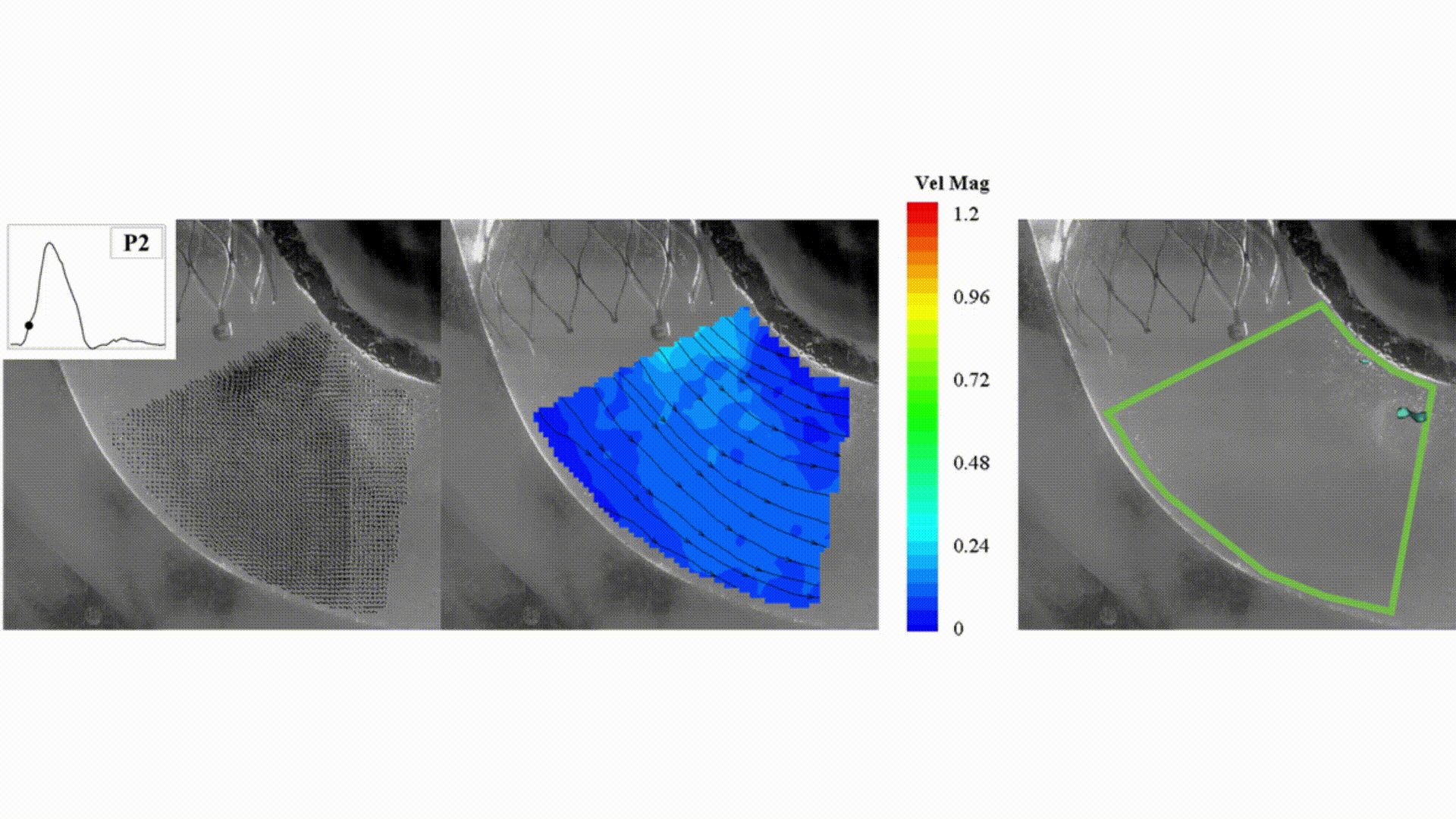Transcatheter Aortic Valve